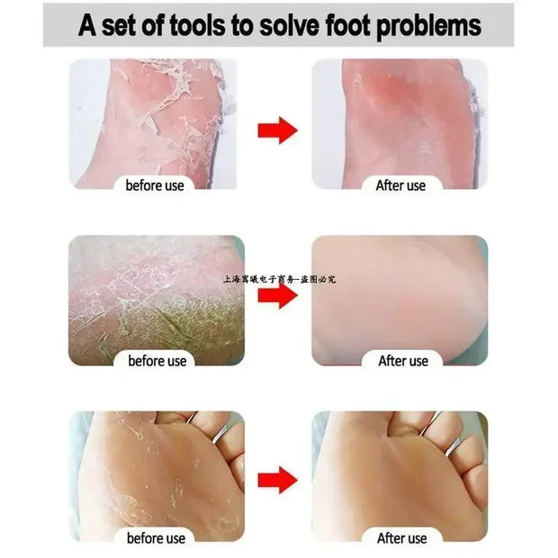 Ponceuse à pied en Acier inoxydable; Dissolvant de Râpe Pied (CMER)